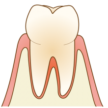 軽度歯周病の場合