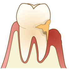 中度歯周病の場合