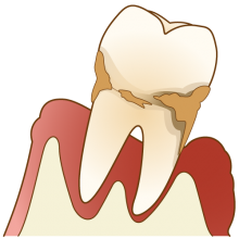 重度歯周病の場合