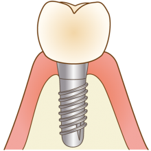 インプラント治療の流れ